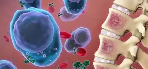 误诊率高达60%?!“伪装高手”多发性骨髓瘤的识别及治疗现状! 误诊率高达60%?!“伪装高手”多发性骨髓瘤的识别及治疗现状!