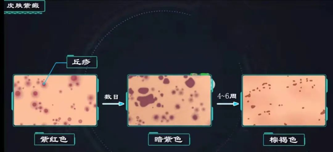 【健康科普】过敏性紫癜怎么办？