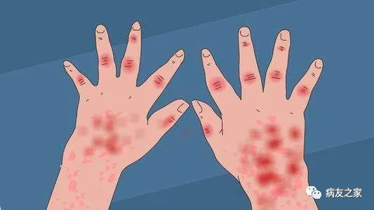 病友故事 | 如果当时.......（连载一）