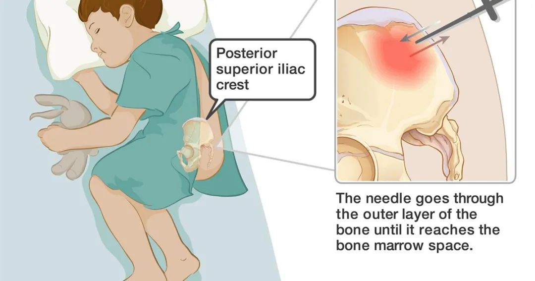 孩子生病后中性粒细胞减少是什么原因?什么时候用升粒细胞的药物? 孩子生病后中性粒细胞减少是什么原因?什么时候用升粒细胞的药物?