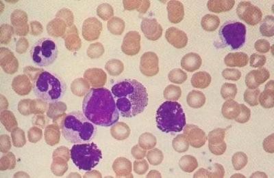 科普宣教 | 什么是急性淋巴细胞白血病? 科普宣教 | 什么是急性淋巴细胞白血病?