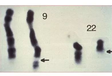 科普宣教 | 什么是急性淋巴细胞白血病? 科普宣教 | 什么是急性淋巴细胞白血病?