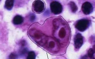 非霍奇金淋巴瘤的化疗方案有哪些？