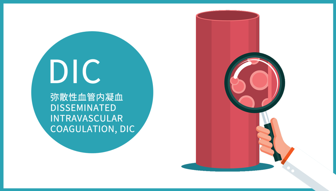 科普:聊聊弥散性血管内凝血(DIC)① 科普:聊聊弥散性血管内凝血(DIC)①
