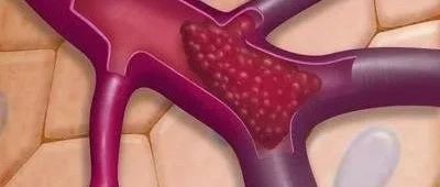 易栓症(血栓形成倾向)与妊娠