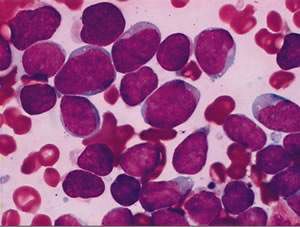 科普宣教 | 什么是急性淋巴细胞白血病? 科普宣教 | 什么是急性淋巴细胞白血病?