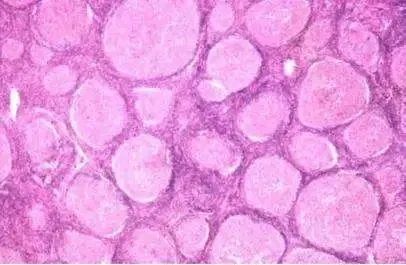 非霍奇金淋巴瘤的化疗方案有哪些？