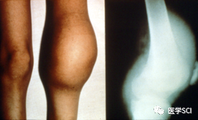 传说中的血友病 传说中的血友病