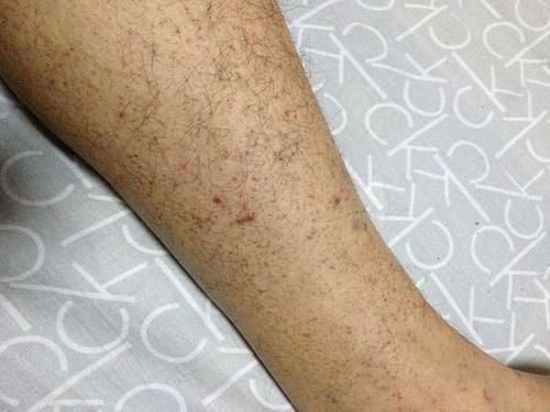 科普宣教 | 什么是急性淋巴细胞白血病? 科普宣教 | 什么是急性淋巴细胞白血病?