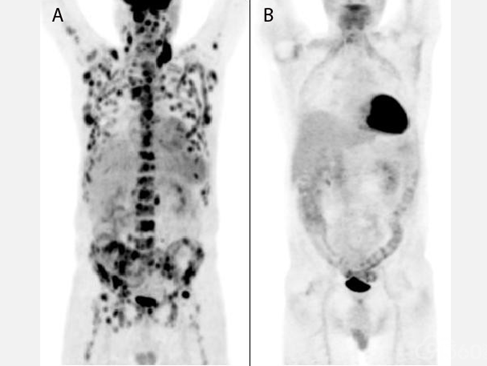 一起了解霍奇金淋巴瘤