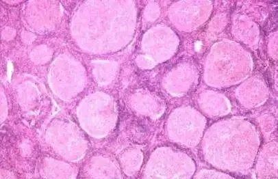 非霍奇金淋巴瘤的化疗方案有哪些？