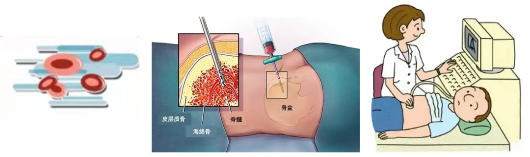 疾病指南 | 原发性血小板增多症诊断与治疗中国专家共识(2016年版)