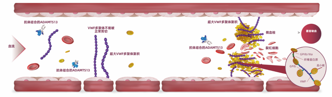 一文读懂:血栓性血小板减少性紫癜的发病机制及诊断流程 一文读懂:血栓性血小板减少性紫癜的发病机制及诊断流程