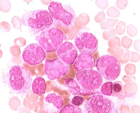 认识急性早幼粒细胞白血病 认识急性早幼粒细胞白血病