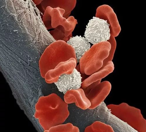 科普宣教 | 什么是急性淋巴细胞白血病? 科普宣教 | 什么是急性淋巴细胞白血病?