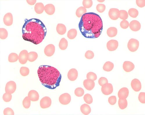 科普宣教 | 什么是急性淋巴细胞白血病? 科普宣教 | 什么是急性淋巴细胞白血病?
