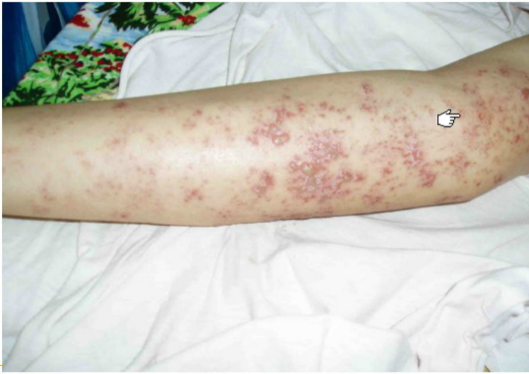 一文回顾丨多发性骨髓瘤的分期、诊疗及预后 一文回顾丨多发性骨髓瘤的分期、诊疗及预后