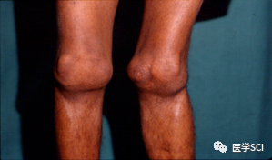 传说中的血友病 传说中的血友病