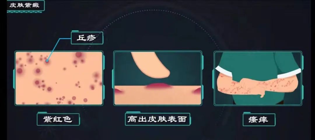 【健康科普】过敏性紫癜怎么办？