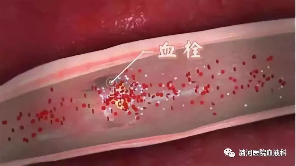 易栓症筛查三项知多少 易栓症筛查三项知多少