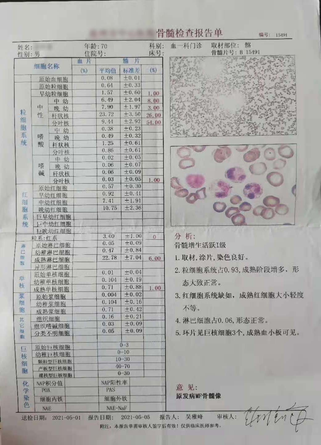 大咖谈病例|景红梅教授点评-原发性骨髓纤维化(PMF)诊疗方法之病例解析