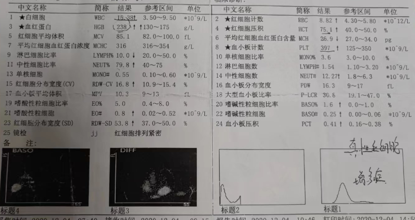 大咖谈病例 | 张敬宇教授:一例真性红细胞增多症的病例点评