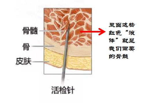 大咖零距离 | MPN家园携手血液专家一起为您揭开有关“骨髓穿刺”的秘密