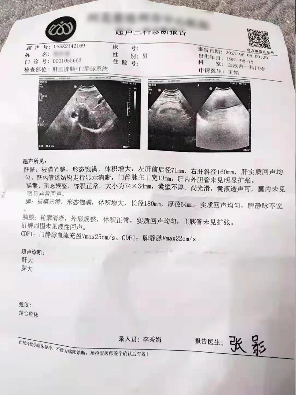 大咖谈病例|景红梅教授点评-原发性骨髓纤维化(PMF)诊疗方法之病例解析