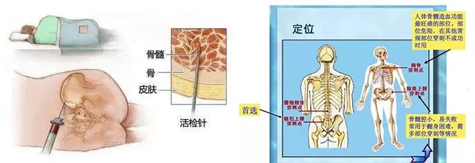 大咖零距离 | MPN家园携手血液专家一起为您揭开有关“骨髓穿刺”的秘密