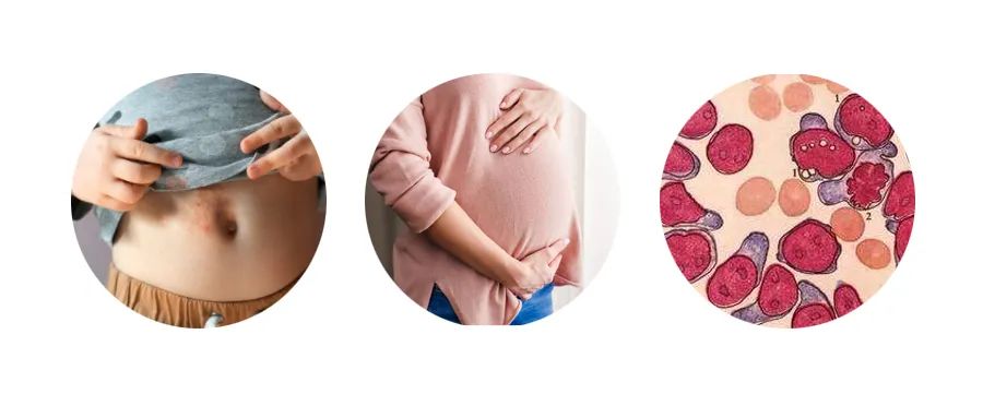 药物介绍 | 关于“羟基脲”的那点事儿 药物介绍 | 关于“羟基脲”的那点事儿