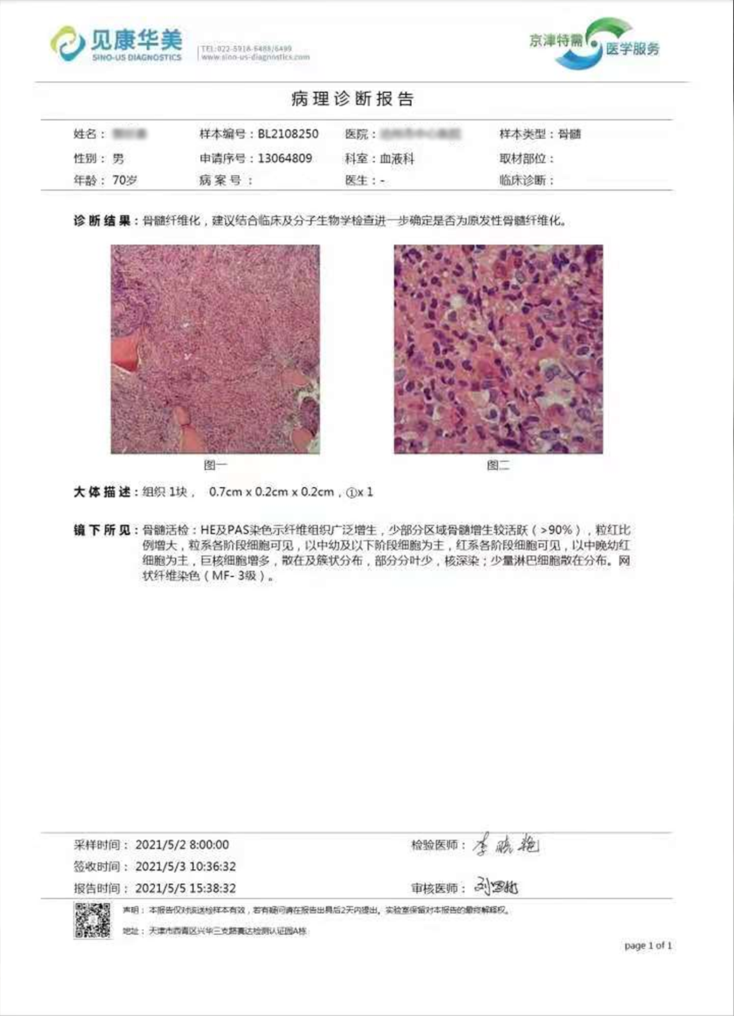 大咖谈病例|景红梅教授点评-原发性骨髓纤维化(PMF)诊疗方法之病例解析