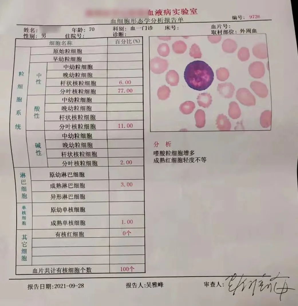 大咖谈病例|景红梅教授点评-原发性骨髓纤维化(PMF)诊疗方法之病例解析