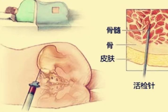 听起来就很痛的骨髓穿刺和骨髓活检,真的很可怕吗?