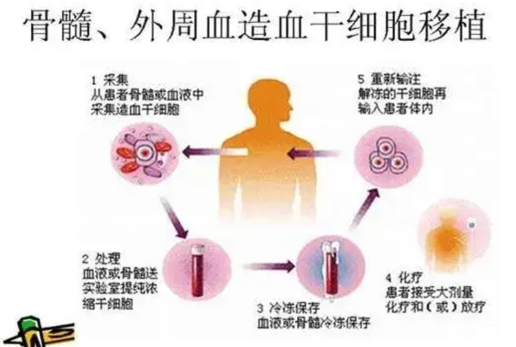 什么是造血干细胞? 骨髓增殖性肿瘤(MPN)与造血干细胞移植,你必须了解的!