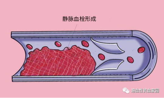 一问医答 | 自身免疫性溶血性贫血(AIHA)常见问题(六)