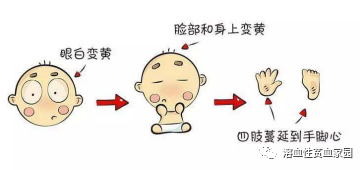 科普时间 | 溶血性贫血,怎么去黄?