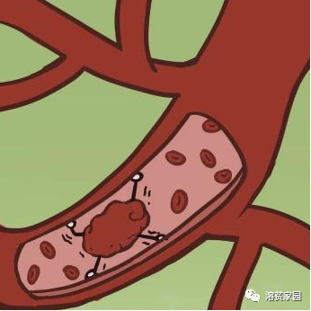 科普时间 | PNH患者可以口服抗凝剂预防血栓吗?