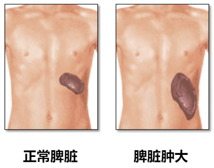捷力呵护MF大咖谈 | 肿瘤防治周:观察还是服药?哪个治疗方案更适合?——大咖细谈制定MF治疗方案的必做检查