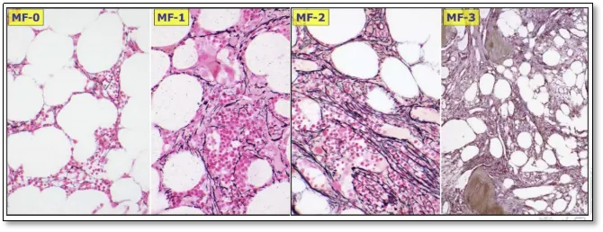 Q&#038;A | 有图有真相，骨髓活检报告应该这样看！