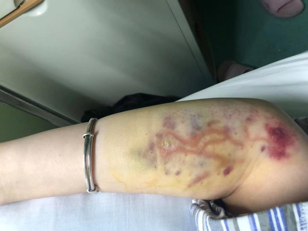 病友故事 | 27岁那年，我查出了白血病......