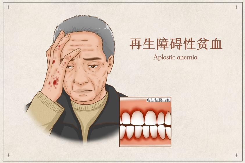 认识疾病 | 再生障碍性贫血分几种?对症治疗攻略看这里