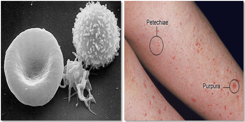 专家讲座 | 郭冬梅教授详解血小板相关疾病鉴别与诊断