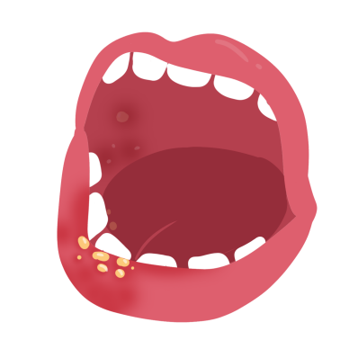 科普时间 | 吃羟基脲口腔溃疡，这可如何是好？！