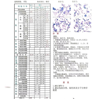 认识检查 | 骨髓穿刺：MDS患者不得不懂的“造血流水线体检单”