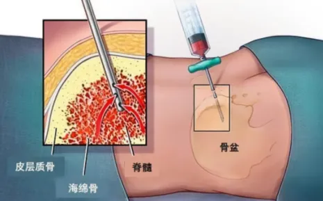 认识检查 | 正确解读“生命说明书”,手把手教你看骨髓穿刺报告!