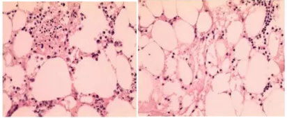 病例分享 | IST联合rhTPO治疗“极重型”再生障碍性贫血，真实病例分享，速来！