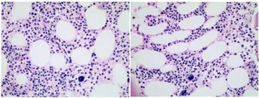 病例分享 | IST联合rhTPO治疗“极重型”再生障碍性贫血，真实病例分享，速来！