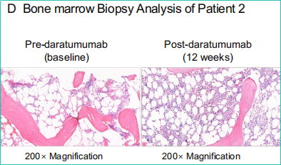科普时间 | 再障患者血小板输注无效时怎么办？CD38可以作为治疗的新靶点