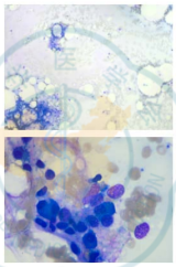 病例分析 | 当免疫治疗无效时......我们也绝不是束手无策!