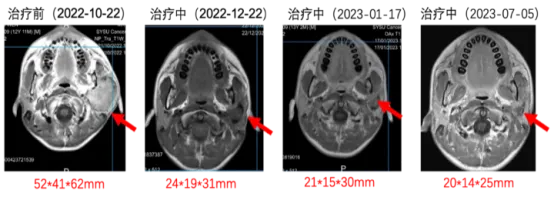 泛癌种精准疗法：新一代NTRK抑制剂佐来曲替尼的临床数据与应